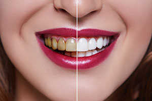 Mejora tu sonrisa con nuestras carillas dentales