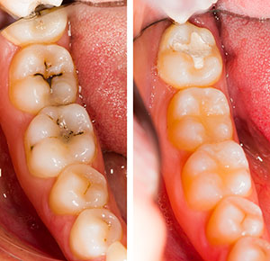 Así quitamos las caries de dientes y muelas. Antes y después de un empaste dental