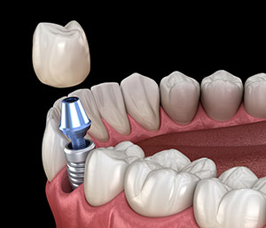 Somos especialistas en la colocación de implantes dentales
