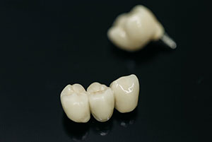 Con las prótesis dentales podemos solucionar las ausencias dentales
