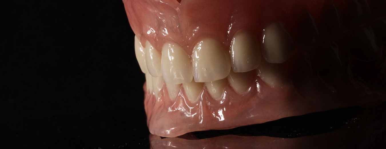Prótesis dental completa removible que los dentistas colocan en pacientes que han perdido sus dientes con resultados muy naturales